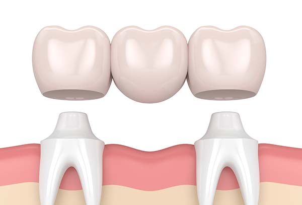 dental-crowns-and-bridges cabramatta