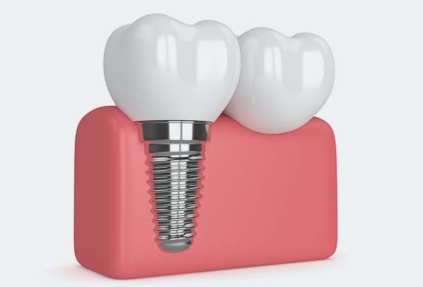 dental-implant-cabramatta