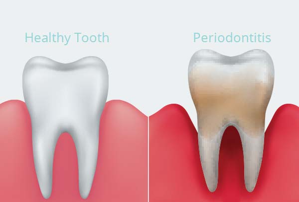 periodontal-disease-treatment-cabramatta