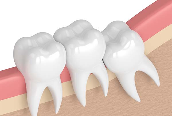 wisdom-teeth-removal-cabramatta